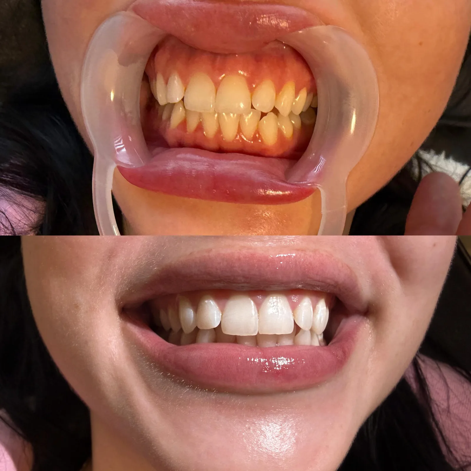 Client's teeth in a retractor before whitening, and the same smile after one session